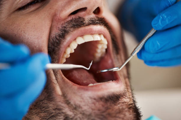 Best Emergency Dentist for Lost Fillings or Crowns in Reiffton, PA